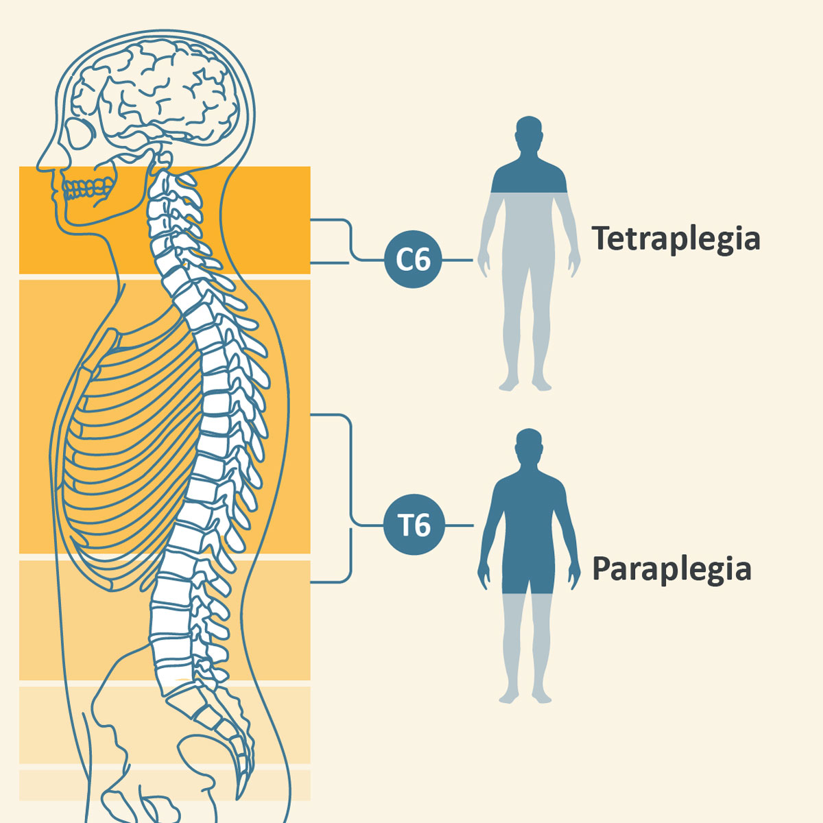 spinal-cord-injury