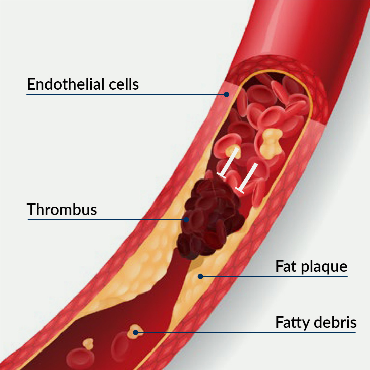 thrombotic-blood-vessel-illustration